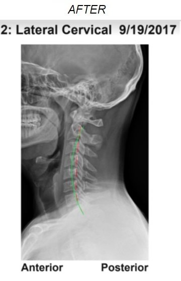 Spine