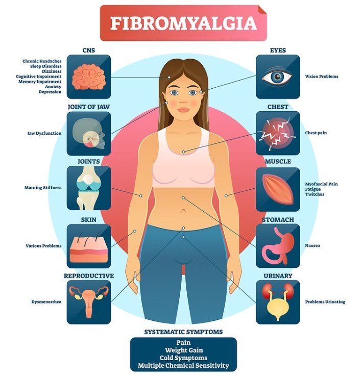 Fibromyalgia