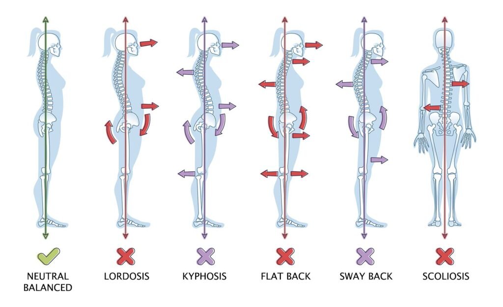 Kyphosis