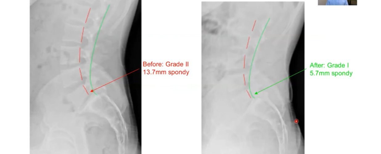 How a Man with a Broken Back Ran a Half Marathon
