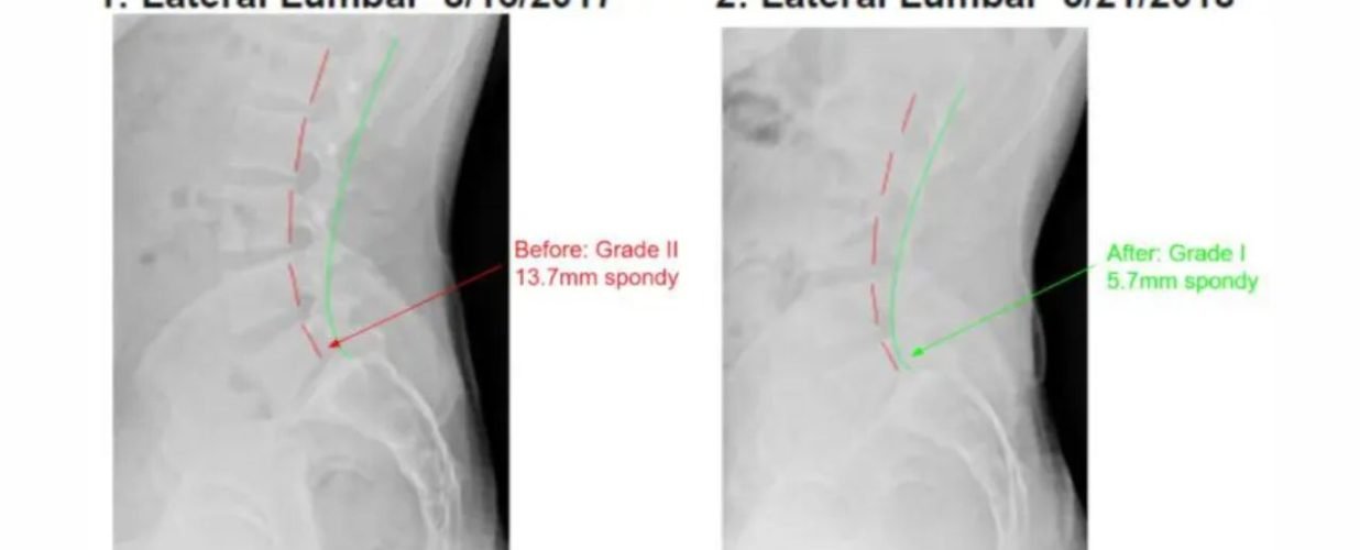 Spondylolisthesis Chiropractic care