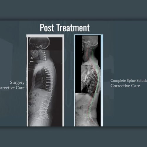 surgery vs chiropractic care